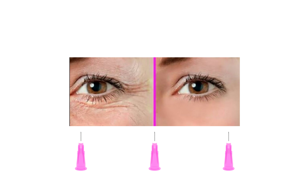 Agulha 32G - agulha de Lebel - 4mm x 0,23mm - 100 agulhas - Estética avançada - ALUR MEDICAL